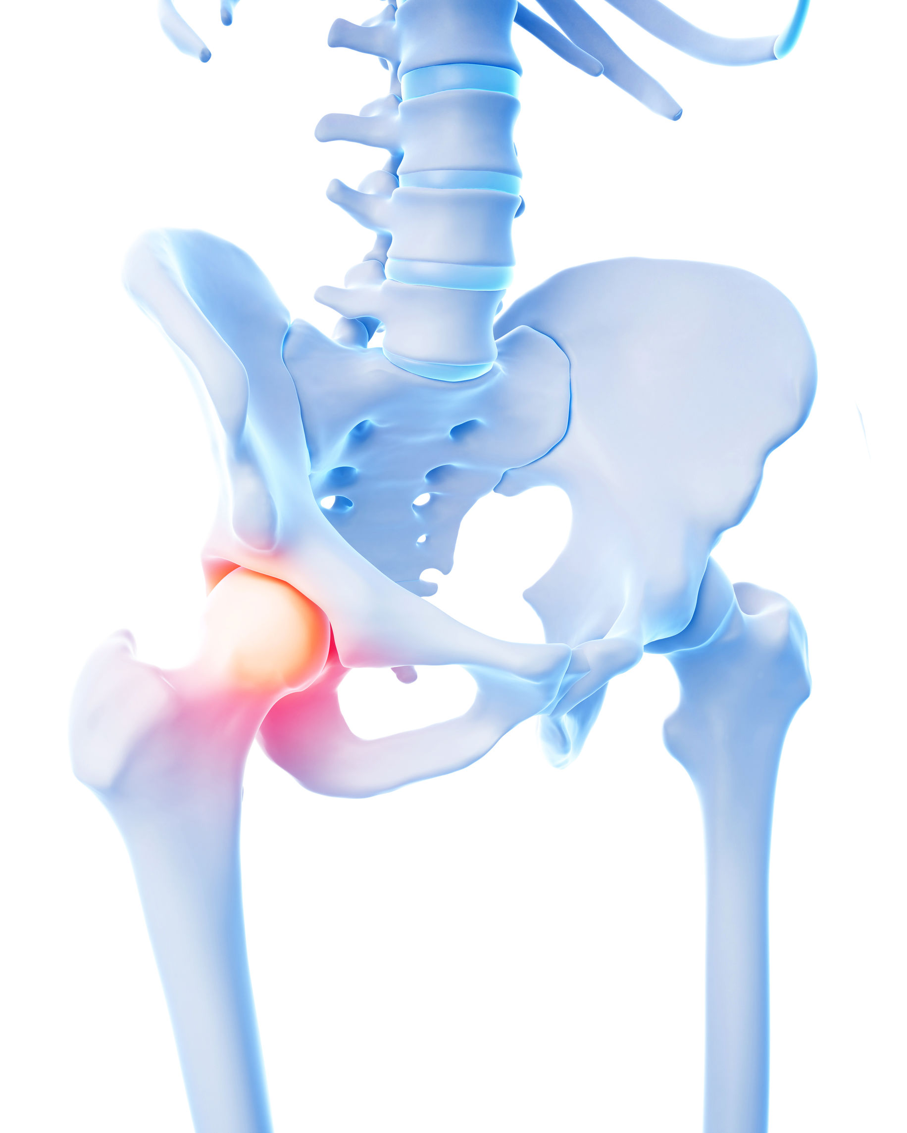 medical 3d illustration of a painful hip joint