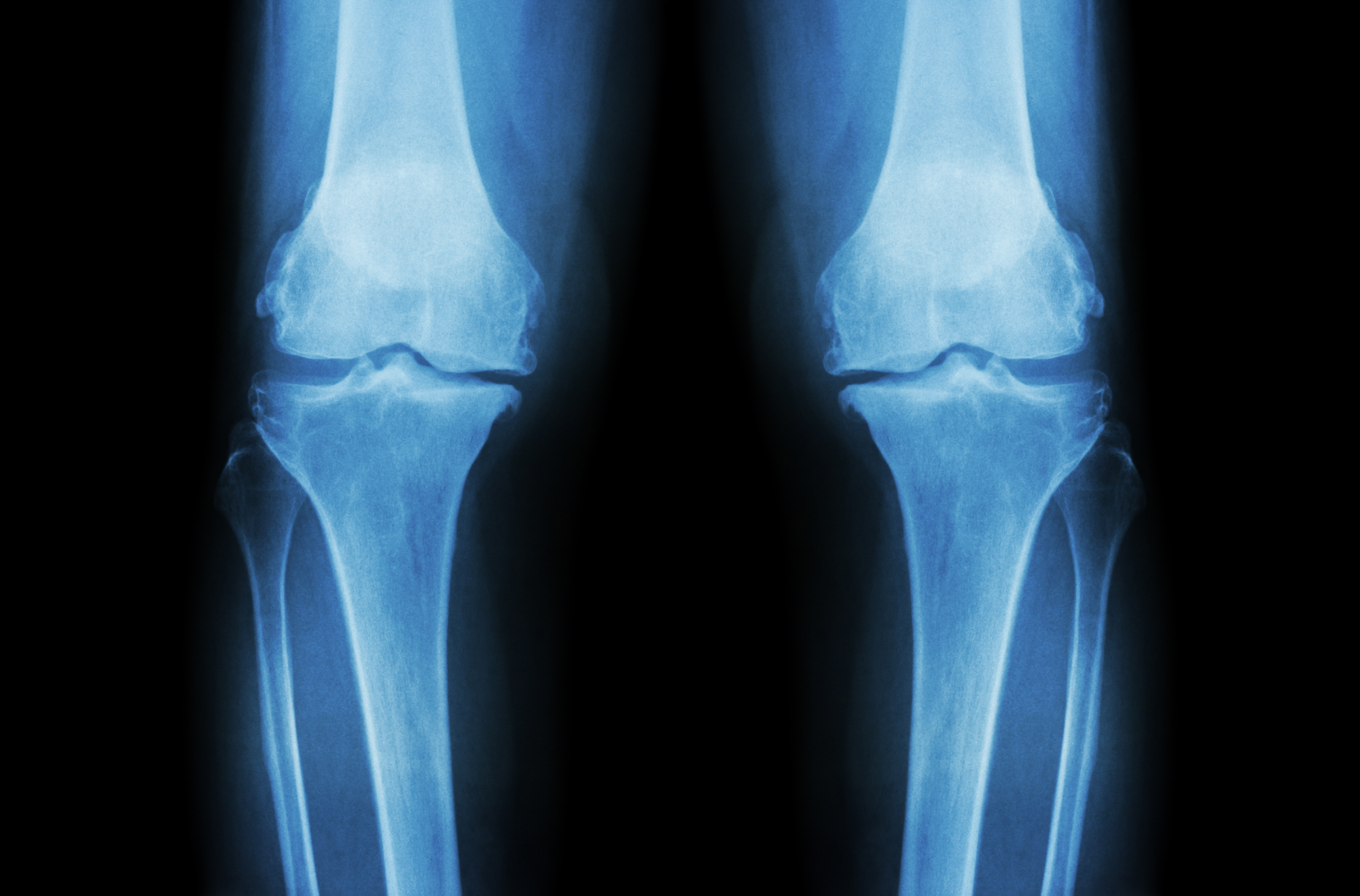Osteoarthritis Knee ( OA Knee )