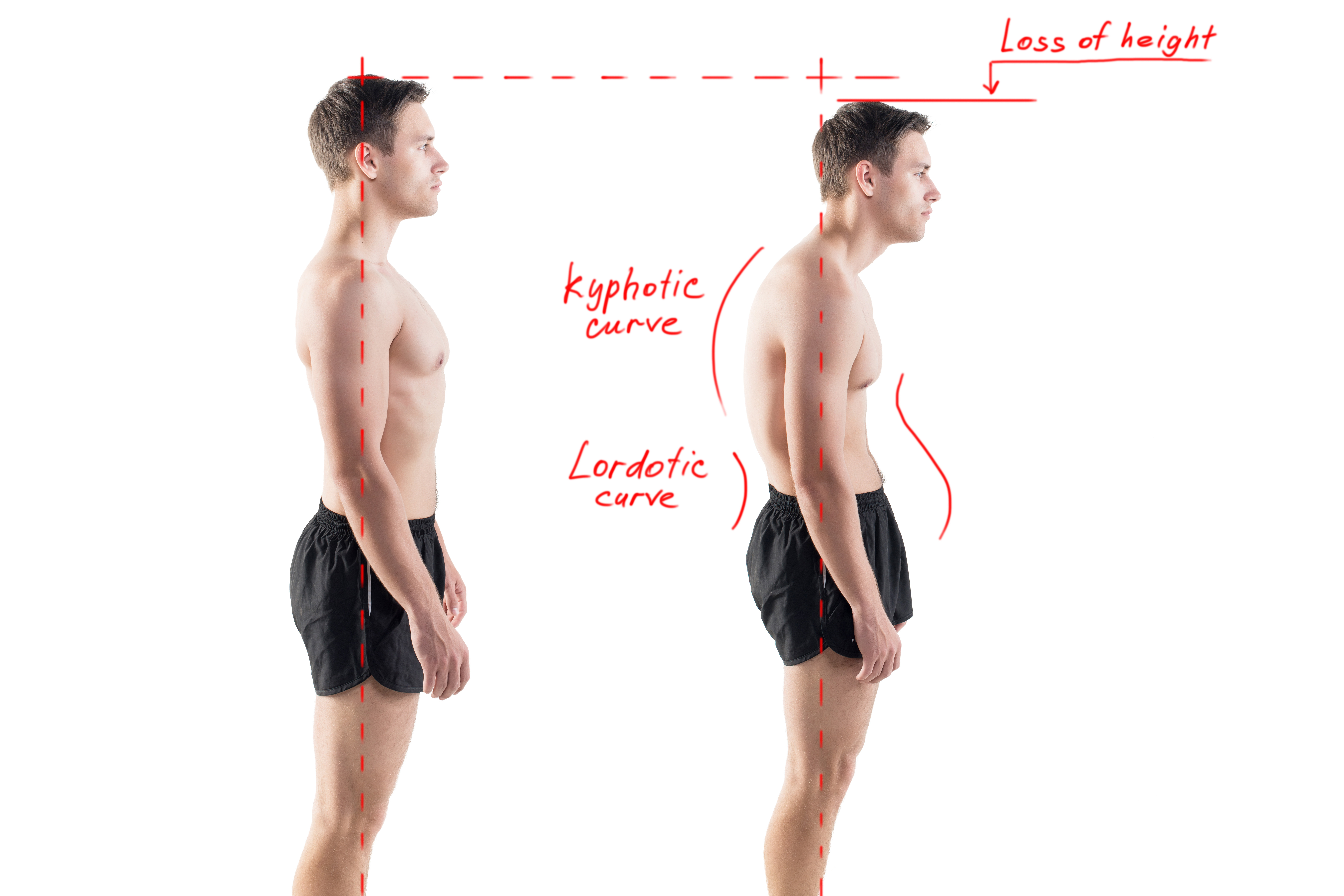 Man with impaired posture position defect scoliosis and ideal bearing